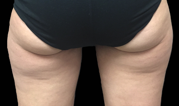 Banana Roll Butt Fat Removal With Coolsculpting