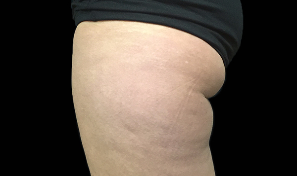 coolsculpting buttocks before and after