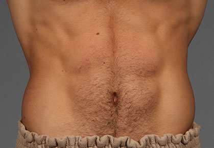 Male Abdomen CoolTone Results