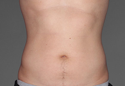 Male Abdomen CoolTone Results