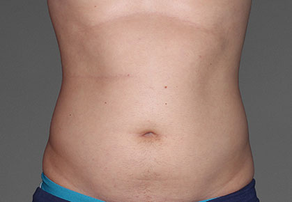 Male Abdomen Before CoolTone Treatment