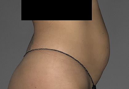 Female Abdomen CoolTone Results