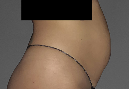 Female Abdomen Before CoolTone Treatment