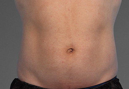 Male Abdomen Before CoolTone Treatment