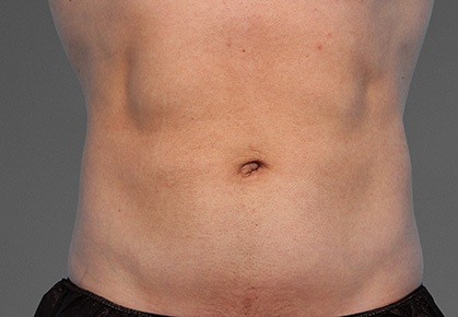 Male Abdomen CoolTone Results