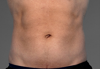 Male Abdomen CoolTone Results